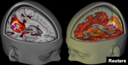 Мозг удзельніка экспэрымэнту, які прыняў ЛСД (справа) і пляцэба (зьлева) на здымках, зробленых з дапамогай магнітна-рэзананснай тамаграфіі дасьледнікамі з Імпэрскага каледжу Лёндану.